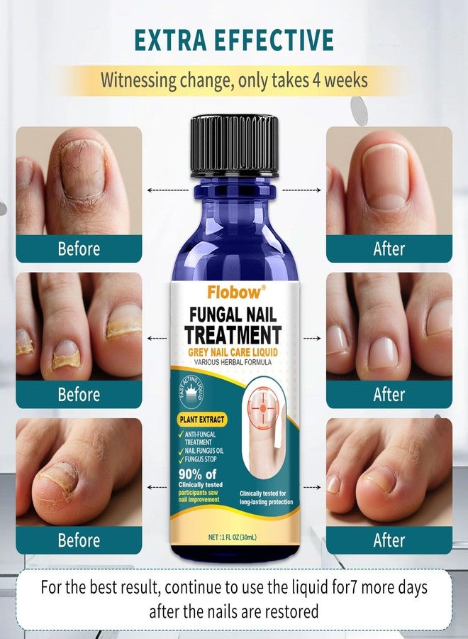 Flobow Toenail Fungus Treatment Extra Strength nail fungus treatment for fingernails, Yellow, Discolored, Broken and Ingrown Nails, ingrown nails and foot fungus treatment extra strength（30ML） - Image 4
